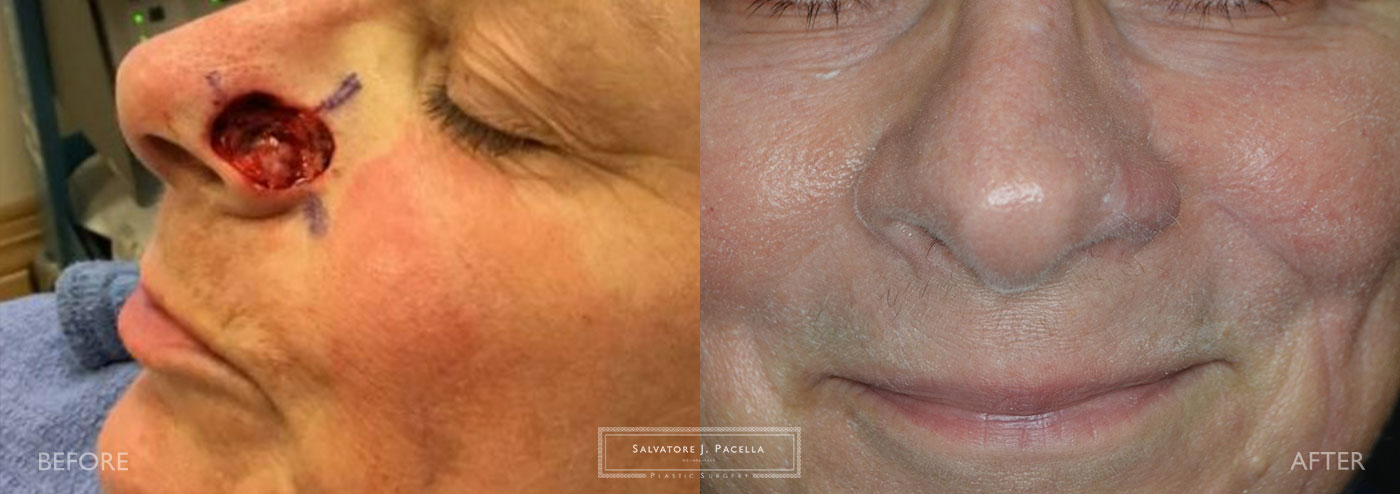 San Diego | La Jolla | Carmel Valley | Del Mar | Scripps Plastic Surgeon | Plastic Surgery | Nasal Expert | Nasal Surgery | Rhinoplasty | Mohs Surgery | Best Plastic Surgery
