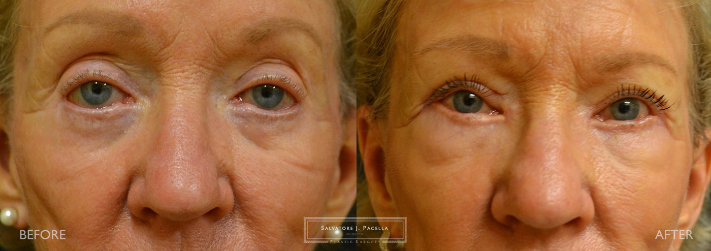 San Diego | La Jolla | Carmel Valley | Del Mar | Encinitas | Plastic Surgery | Cosmetic Surgery | Eyelid Expert | Eyelid Surgery | Ptosis | Oculoplastic Surgery | Browlift | Blepharoplasty | Oculoplastic Surgery | Facial Rejuvenation | Top Plastic Surgeon