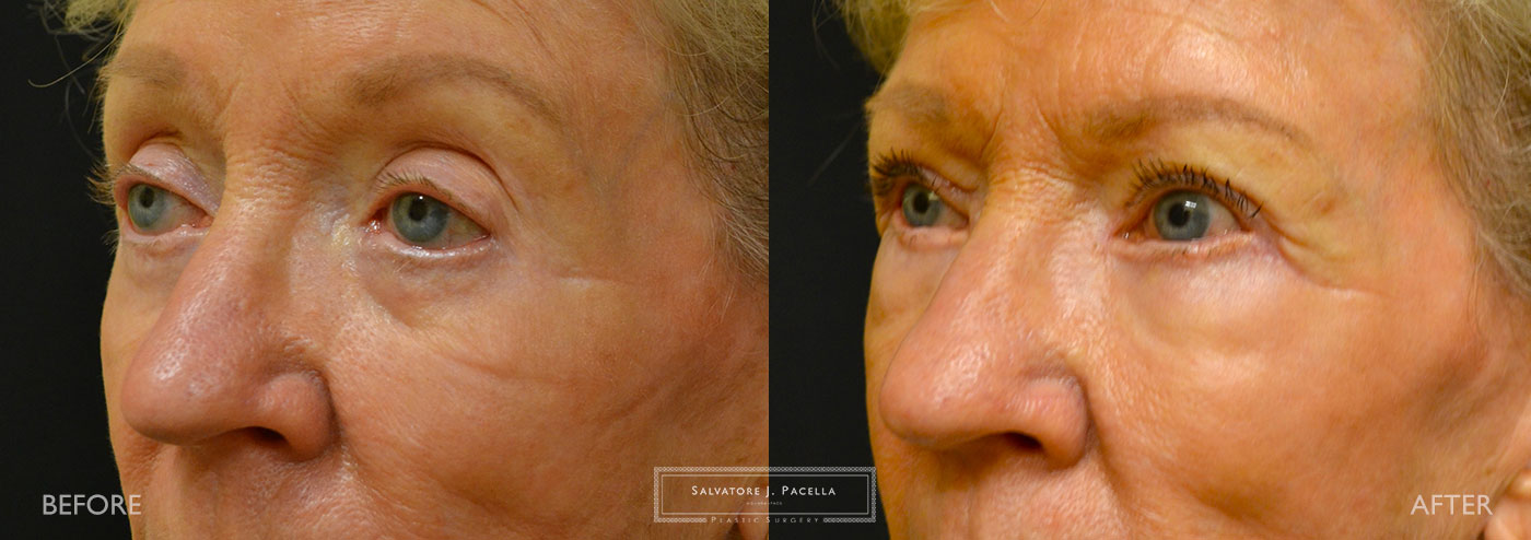San Diego | La Jolla | Carmel Valley | Del Mar | Encinitas | Plastic Surgery | Cosmetic Surgery | Eyelid Expert | Eyelid Surgery | Ptosis | Oculoplastic Surgery | Browlift | Blepharoplasty | Oculoplastic Surgery | Facial Rejuvenation | Top Plastic Surgeon