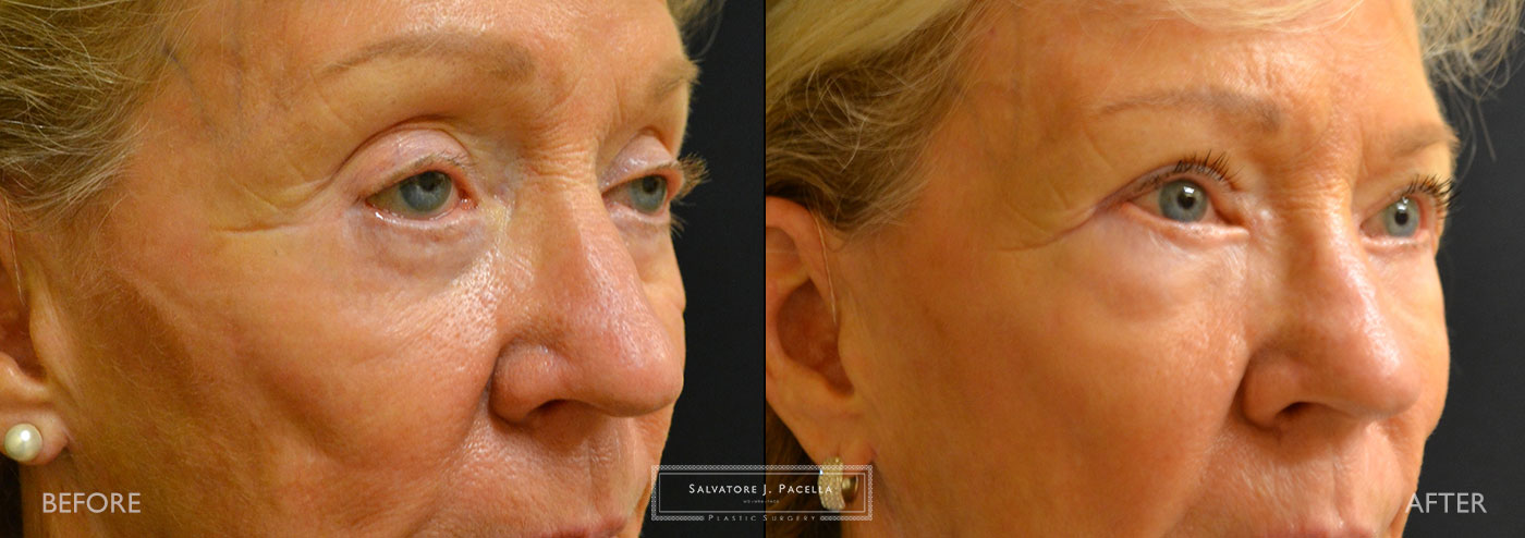 San Diego | La Jolla | Carmel Valley | Del Mar | Encinitas | Plastic Surgery | Cosmetic Surgery | Eyelid Expert | Eyelid Surgery | Ptosis | Oculoplastic Surgery | Browlift | Blepharoplasty | Oculoplastic Surgery | Facial Rejuvenation | Top Plastic Surgeon
