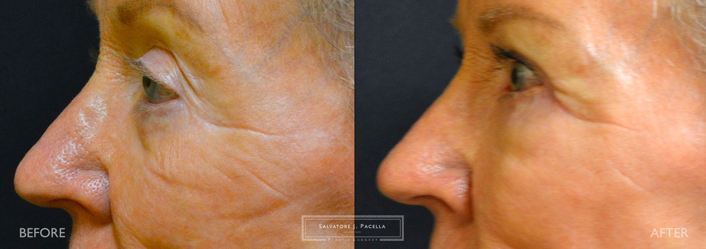San Diego | La Jolla | Carmel Valley | Del Mar | Encinitas | Plastic Surgery | Cosmetic Surgery | Eyelid Expert | Eyelid Surgery | Ptosis | Oculoplastic Surgery | Browlift | Blepharoplasty | Oculoplastic Surgery | Facial Rejuvenation | Top Plastic Surgeon