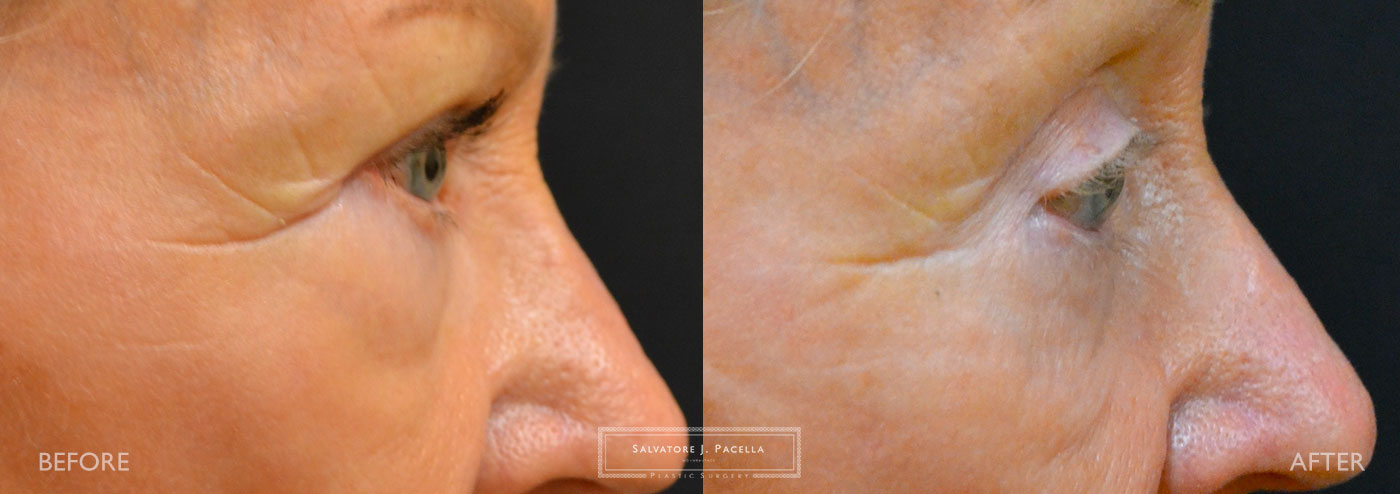 San Diego | La Jolla | Carmel Valley | Del Mar | Encinitas | Plastic Surgery | Cosmetic Surgery | Eyelid Expert | Eyelid Surgery | Ptosis | Oculoplastic Surgery | Browlift | Blepharoplasty | Oculoplastic Surgery | Facial Rejuvenation | Top Plastic Surgeon