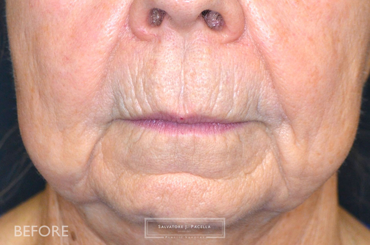 Before image