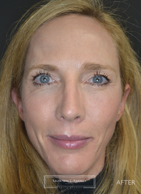 After image