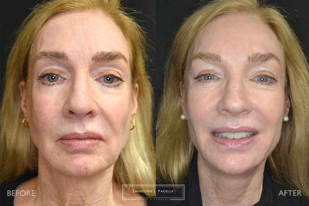 San Diego | La Jolla | Carmel Valley | Del Mar | Encinitas | Plastic Surgery | Cosmetic Surgery | Facelift | Browlift | Fat Transfer | Facial Rejuvenation | Top | Plastic Surgeon | Deep plane facelift