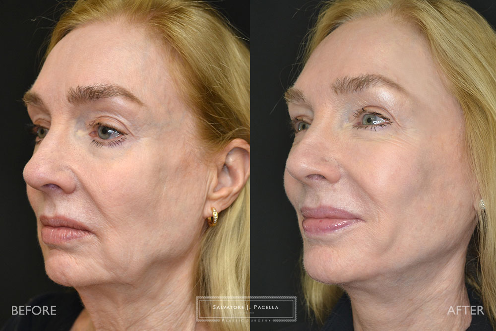 San Diego | La Jolla | Carmel Valley | Del Mar | Encinitas | Plastic Surgery | Cosmetic Surgery | Facelift | Browlift | Fat Transfer | Facial Rejuvenation | Top | Plastic Surgeon | Deep plane facelift