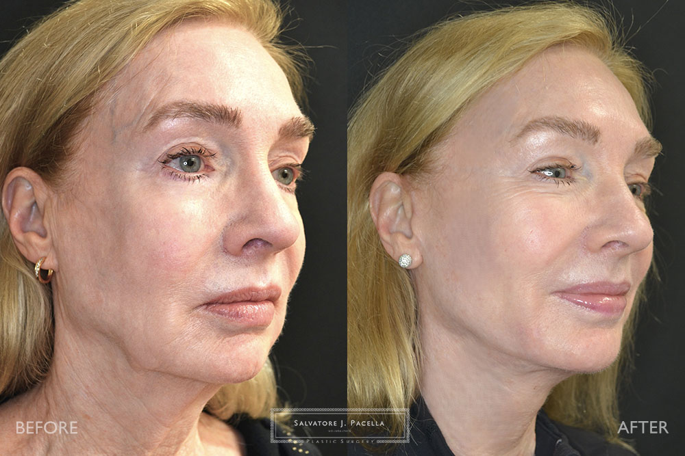 San Diego | La Jolla | Carmel Valley | Del Mar | Encinitas | Plastic Surgery | Cosmetic Surgery | Facelift | Browlift | Fat Transfer | Facial Rejuvenation | Top | Plastic Surgeon | Deep plane facelift