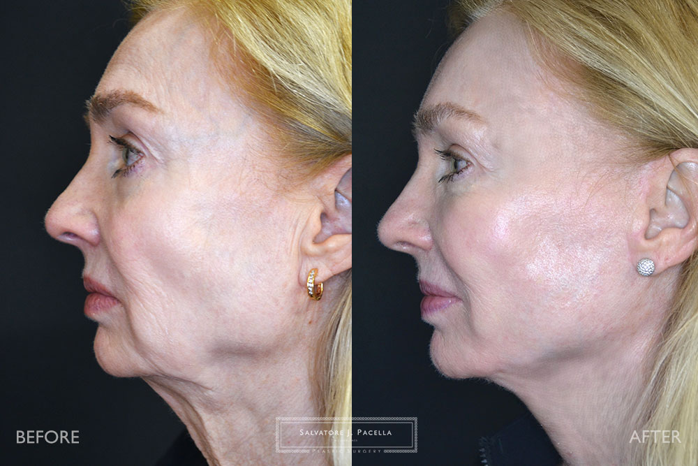 San Diego | La Jolla | Carmel Valley | Del Mar | Encinitas | Plastic Surgery | Cosmetic Surgery | Facelift | Browlift | Fat Transfer | Facial Rejuvenation | Top | Plastic Surgeon | Deep plane facelift
