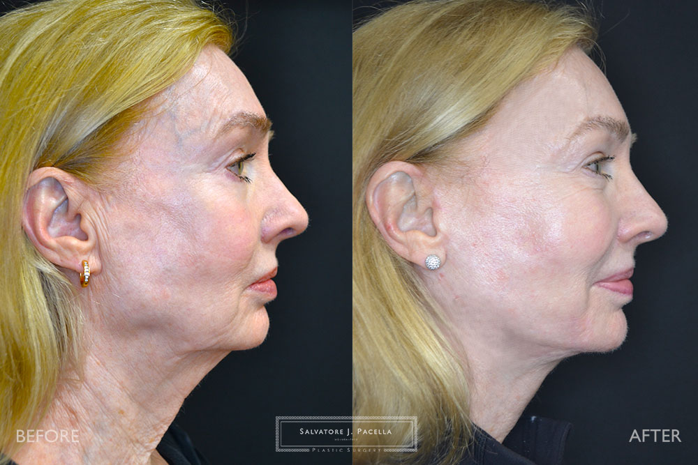 San Diego | La Jolla | Carmel Valley | Del Mar | Encinitas | Plastic Surgery | Cosmetic Surgery | Facelift | Browlift | Fat Transfer | Facial Rejuvenation | Top | Plastic Surgeon | Deep plane facelift