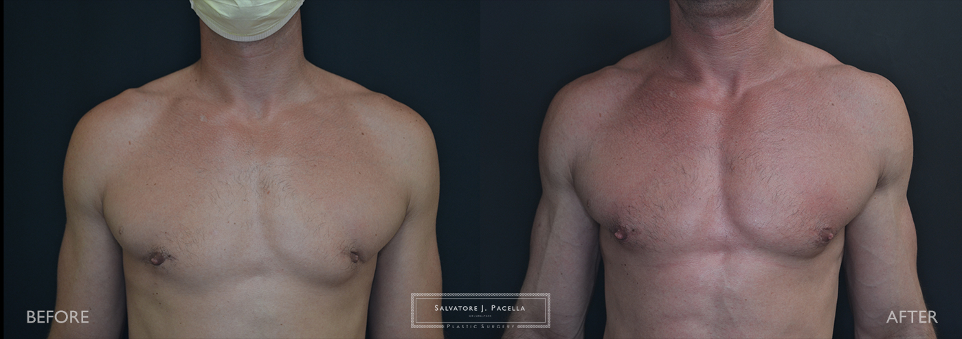 San Diego | La Jolla | Carmel Valley | Del Mar | Plastic Surgery | Gynecomastia | Male Breast Reduction | Top Plastic Surgeon | Scripps Plastic Surgeon