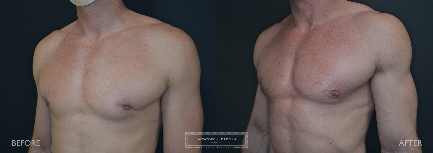 San Diego | La Jolla | Carmel Valley | Del Mar | Plastic Surgery | Gynecomastia | Male Breast Reduction | Top Plastic Surgeon | Scripps Plastic Surgeon