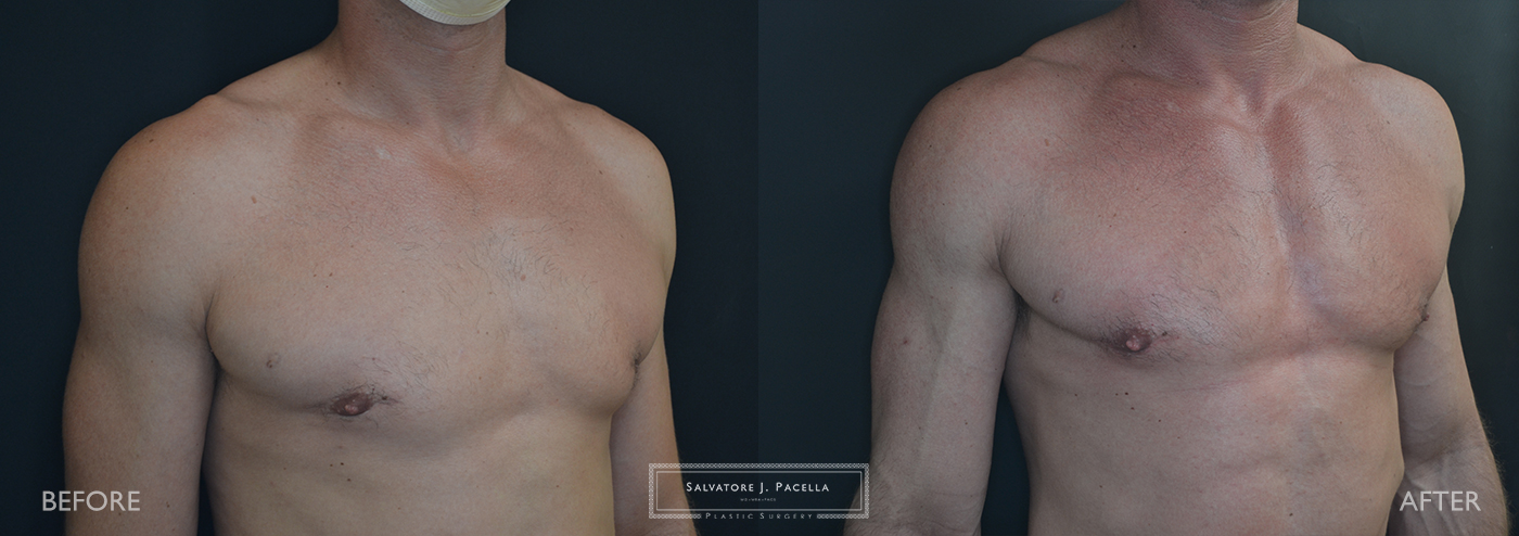 San Diego | La Jolla | Carmel Valley | Del Mar | Plastic Surgery | Gynecomastia | Male Breast Reduction | Top Plastic Surgeon | Scripps Plastic Surgeon