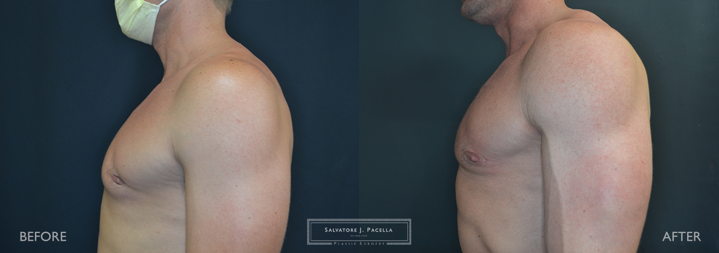 San Diego | La Jolla | Carmel Valley | Del Mar | Plastic Surgery | Gynecomastia | Male Breast Reduction | Top Plastic Surgeon | Scripps Plastic Surgeon