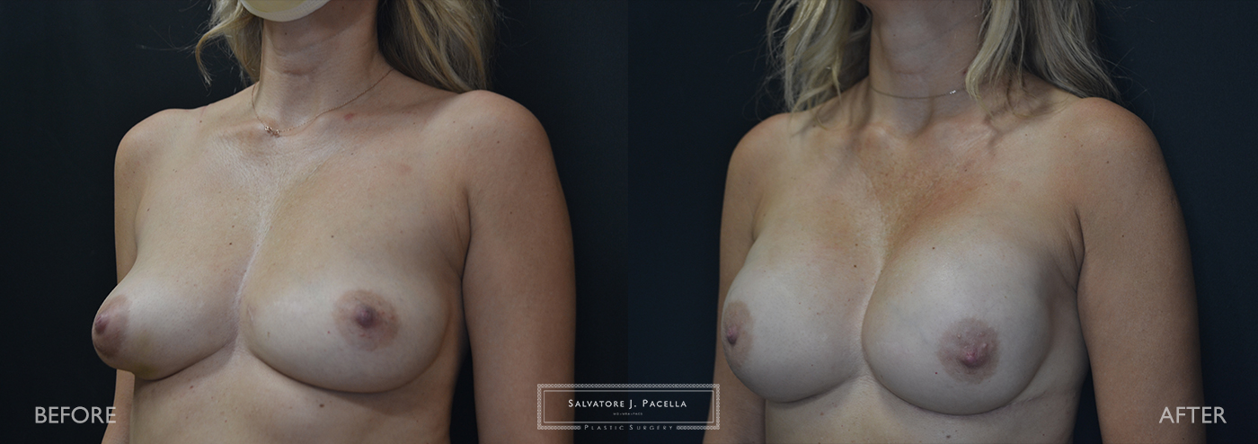 2-stage breast reconstruction following breast cancer in 45-year-old woman