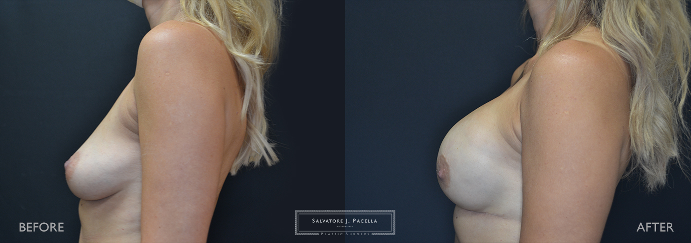Dr. Pacella implant-based breast reconstruction after mastectomy, San Diego