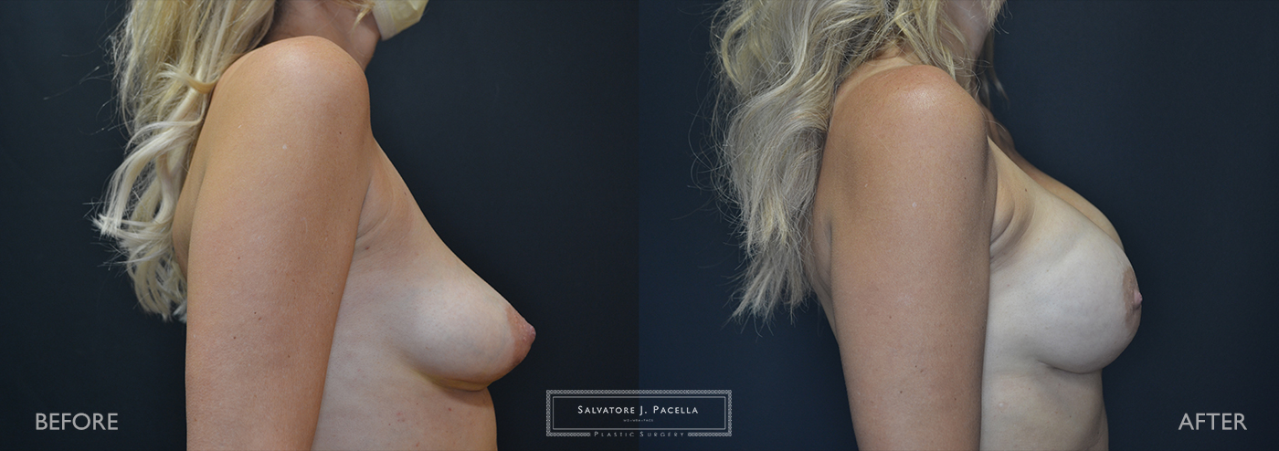 Natural-looking breast reconstruction with nipple preservation and fat transfer